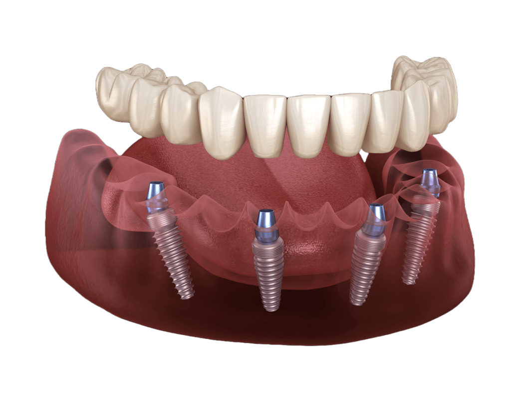 All-on-4 Implants: The Ultimate Smile Transformation Guide
