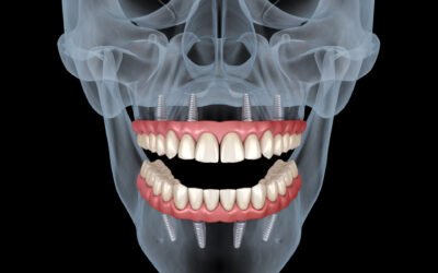 All-on-4 Implants: Transforming Smiles and Lives
