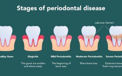 The Stages of Gum Disease: Understanding and Preventing a Silent Threat