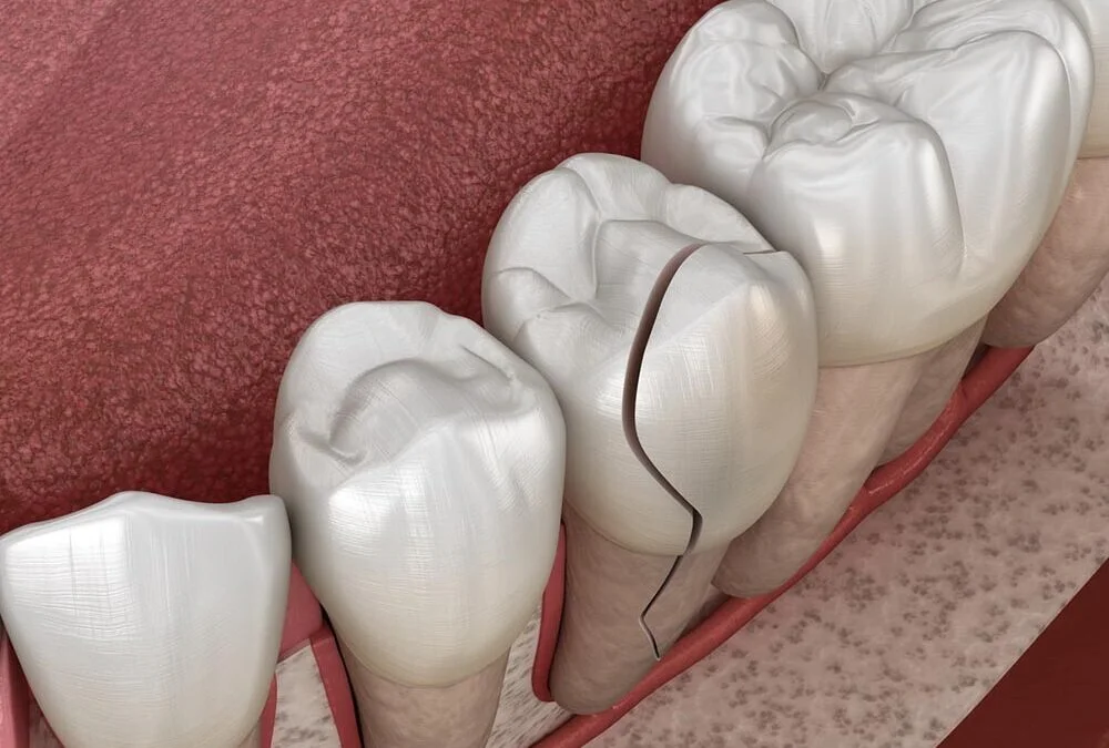 Navigating Cracked Tooth Emergencies: Repair Costs and Quick Actions