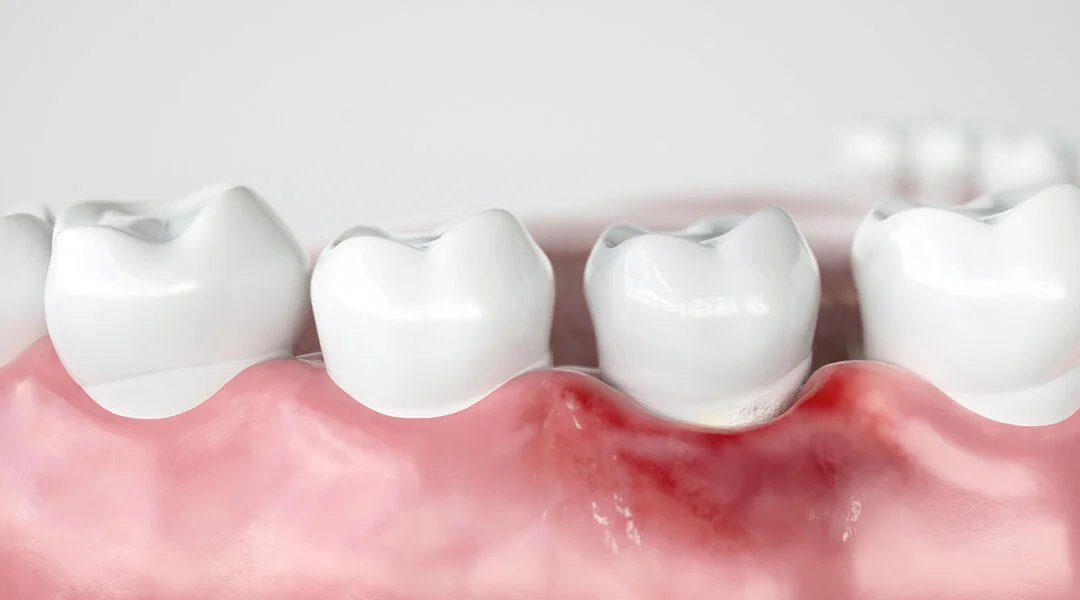 From Plaque to Prevention: Understanding Gingivitis for a Healthier Smile