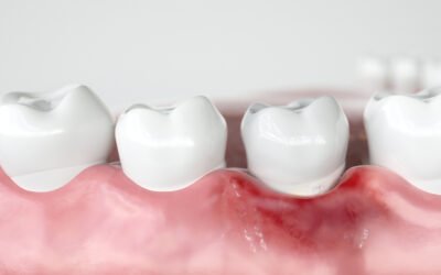 From Plaque to Prevention: Understanding Gingivitis for a Healthier Smile