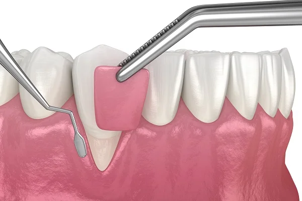 Understanding Gum Surgeries: Different Types and the Gum Grafting Procedure