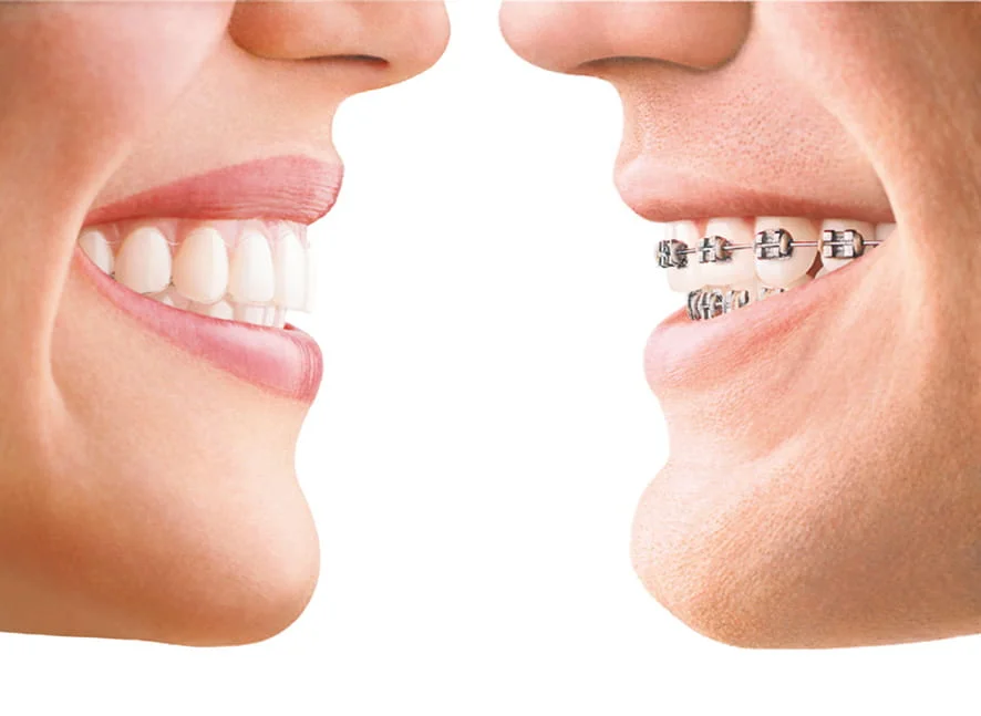 The Advantages of Invisalign Compared to Traditional Braces